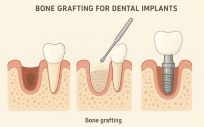 Bone Grafting for Dental Implants: Your Complete Guide