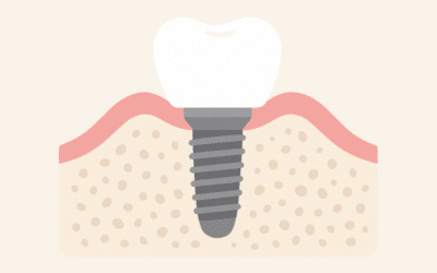 Bone Graft for Implant: Your Guide