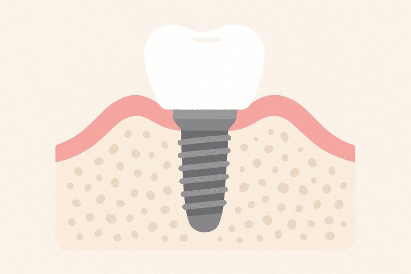 Bone Graft for Implant: Your Guide
